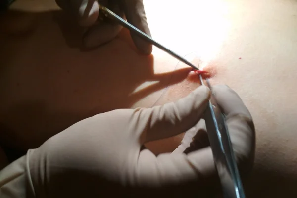 Lumps and Bumps Surgeries